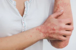 What is Excoriation disorder (skin picking disorder)?