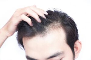 Stress Hair Loss: Causes, Signs & Recovery Timeline